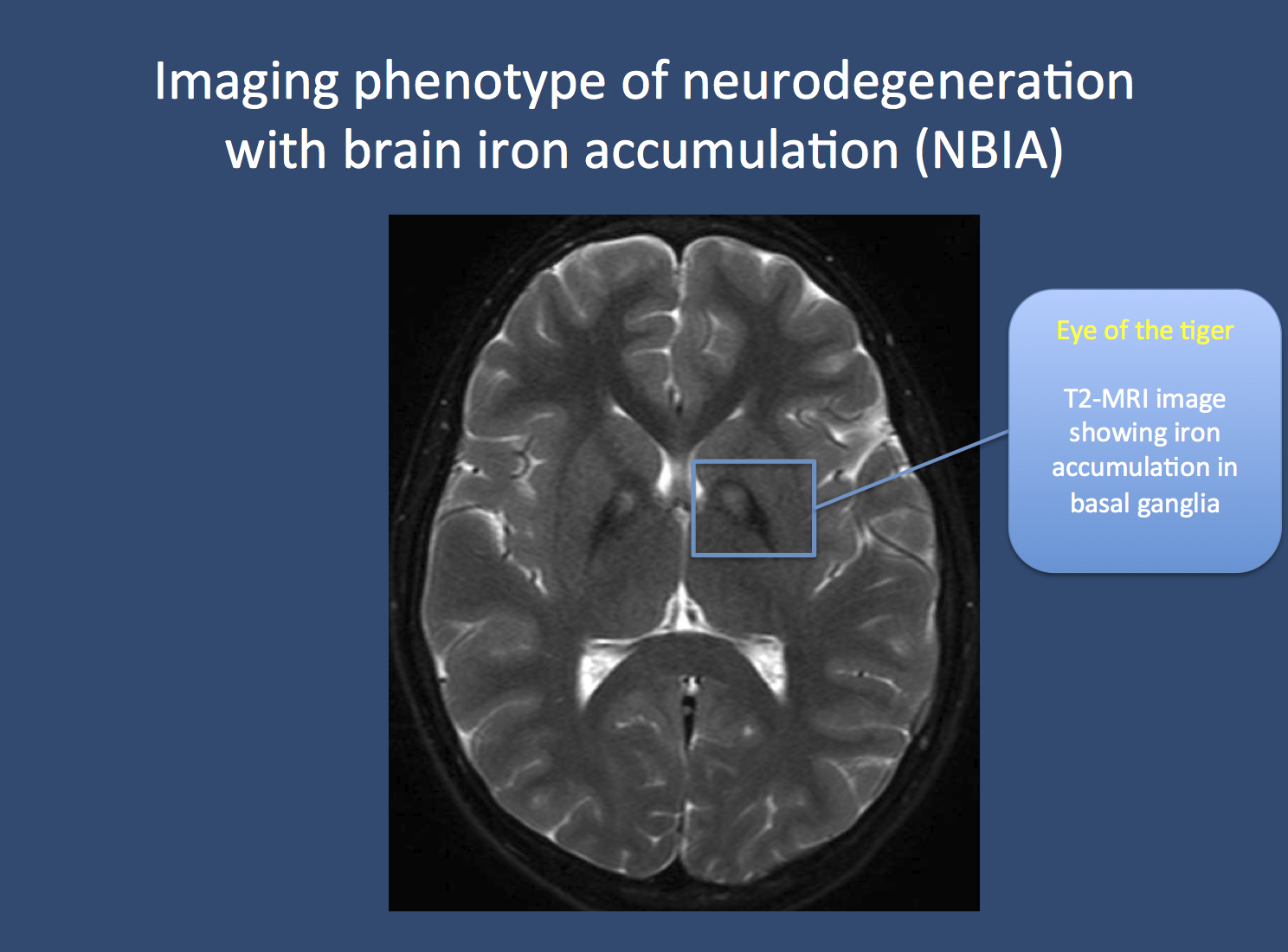 The eye of the tiger. Pantothenate kinase-associated neurodegeneration (PKAN), formerly known as Hallervorden-Spatz disease, is usually associated with a pathognomonic finding on MRI imaging. Due to the accumulation of iron in the basal ganglia, two black spots can be seen, which is referred to as the “eye of the tiger” sign. PKAN is part of a group of disorders referred to as neurodegeneration with brain iron accumulation. Image from Wikimedia commons (http://commons.wikimedia.org/wiki/File:Pkan-basal-ganglia-MRI.JPG), within the framework of the Creative Commons license. 